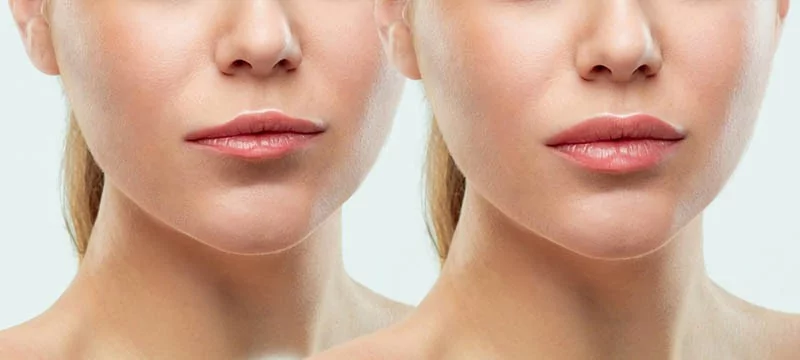 עיבוי שפתיים לפני ואחרי תמונה