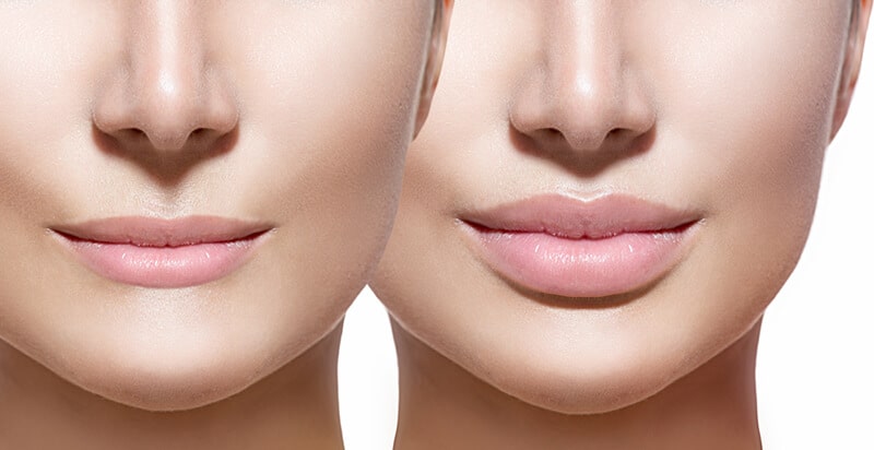 עיבוי שפתיים באמצעות חומצה היאלורונית בשפתיים- להמחשה בלבד
